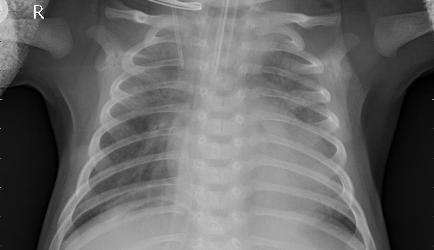 Frontal chest radiograph of a young child, right marker upper left